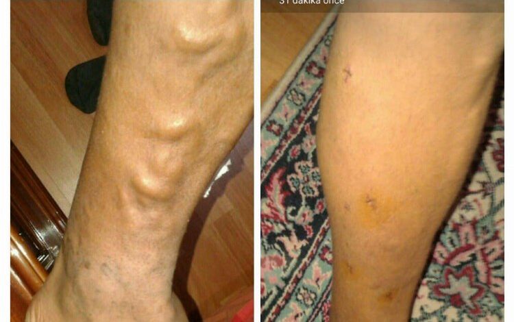 Sıcak havalarda varise dikkat! Sıcak havalarda varise dikkat!