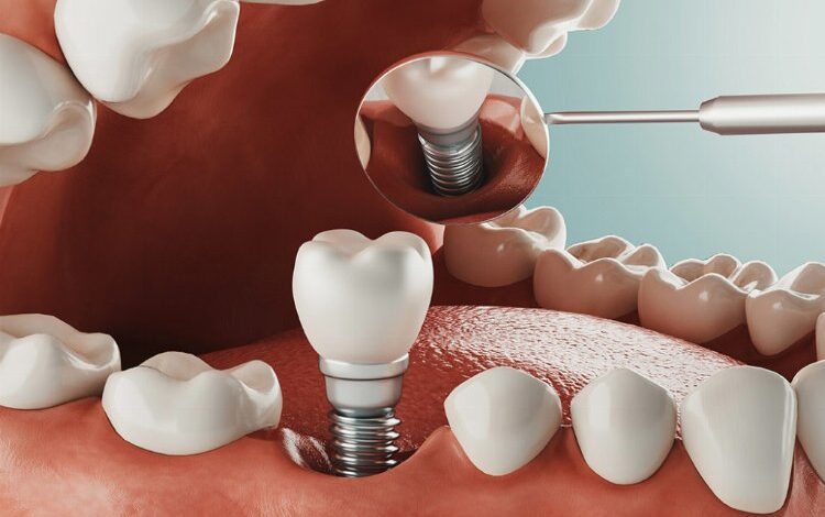 Diş tedavisinde implant zorlu bir süreç mi? Diş tedavisinde implant zorlu bir süreç mi?