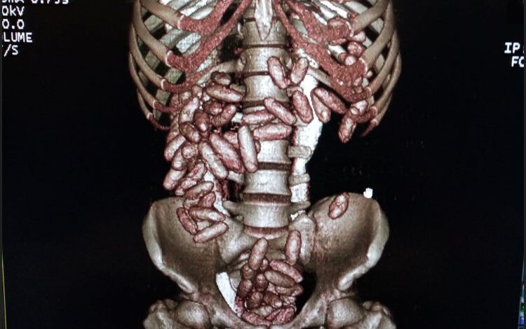 Midesindeki kokain ile yakalandı