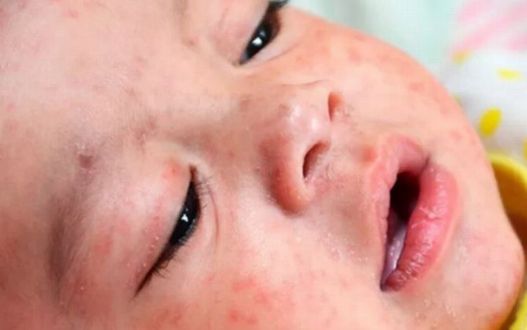 Kızamık vakalarında korkutan artış! Kızamık vakalarında korkutan artış!