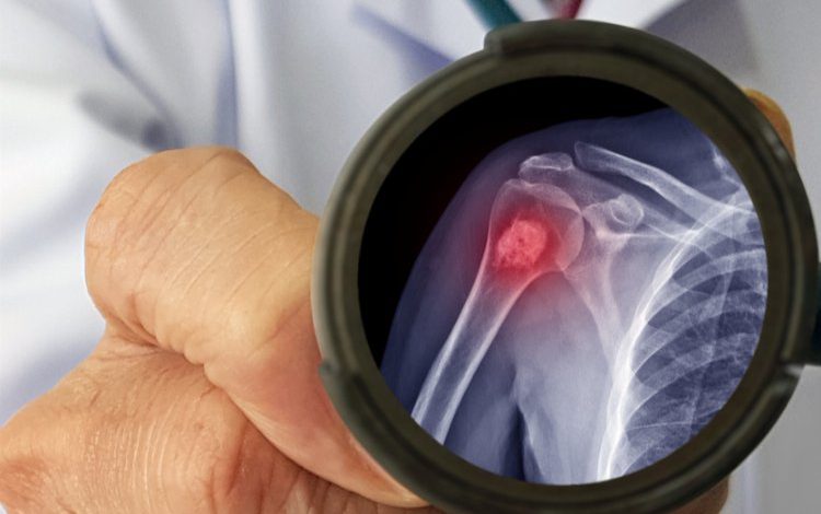 Dikkat! Bu hastalık sinsice ilerliyor! Dikkat! Bu hastalık sinsice ilerliyor!