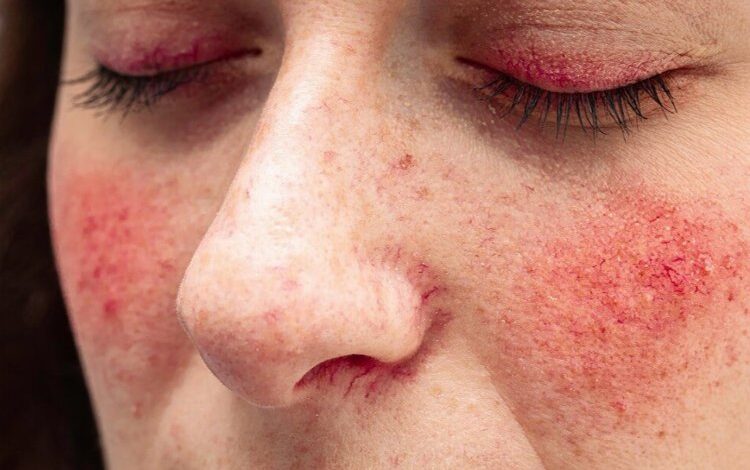 Sıcaklarda ‘gül hastalığı’na dikkat!