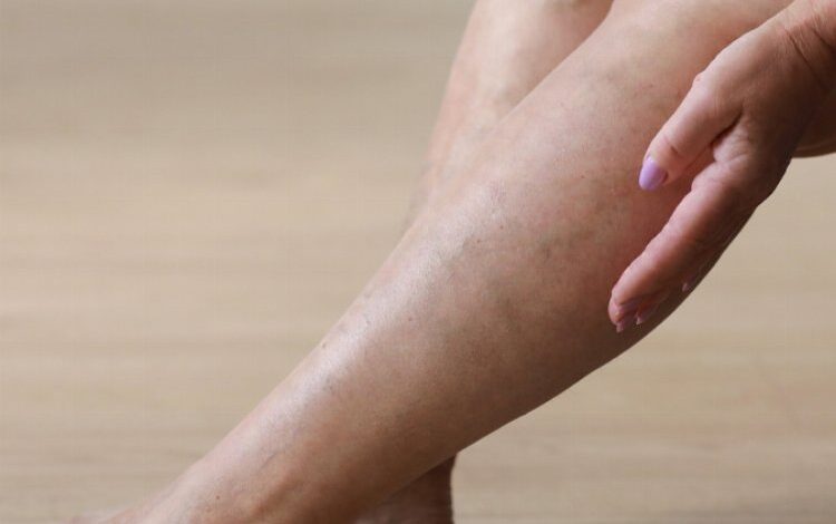 Sıcak havalar varis şikayetlerini de arttırıyor! Sıcak havalar varis şikayetlerini de arttırıyor!