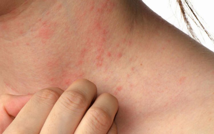 Akşam saatlerinde yoğunlaşan kaşıntıya dikkat! Akşam saatlerinde yoğunlaşan kaşıntıya dikkat!